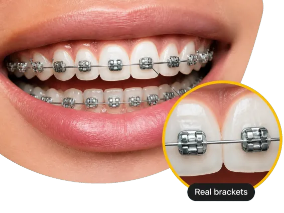Why Choose 1 Macro Smile Real Metal Braces Loupe
